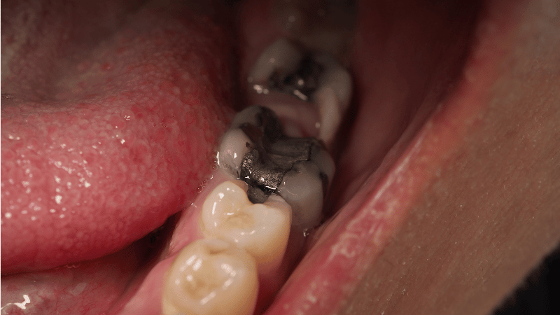 दांत दर्द का उपचार 